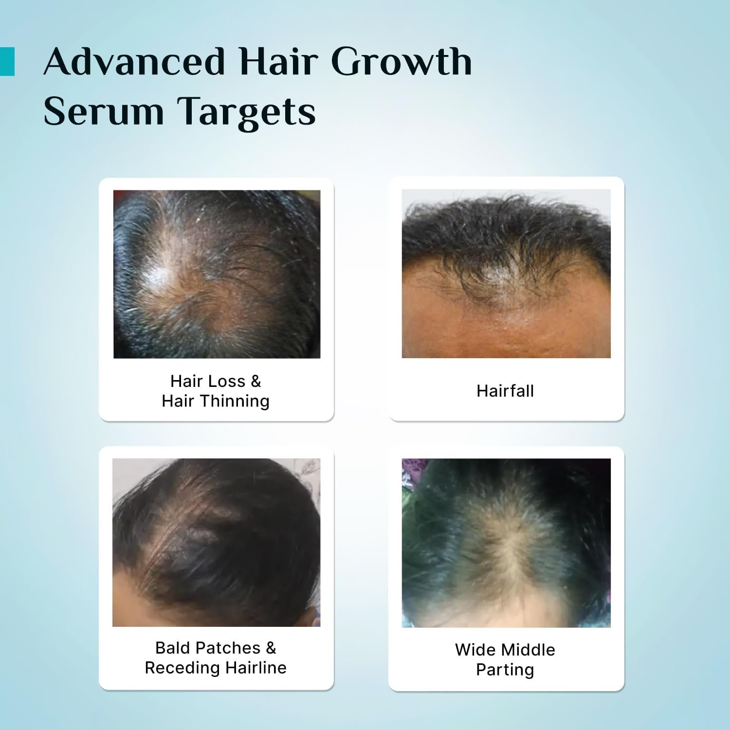 Pilgrim Advanced Hair Growth Serum with 3% Redensyl & 4% AnaGain -30ml New Hair Growth in 28 Days, Korean Black Rice, Rosemary, Reduce Hair Fall, Hair Regrowth, Increase Hair Density, Thicke thumbnail