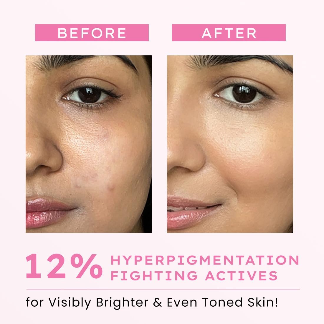 Hyphen Advanced De-Pigmentation Serum For Hyperpigmentation, Melasma, Dark Spots & Scars With 2% Kojic Acid | Visibly Brightens & Even Tones Skin | Serum For Women & Men - 30ml thumbnail
