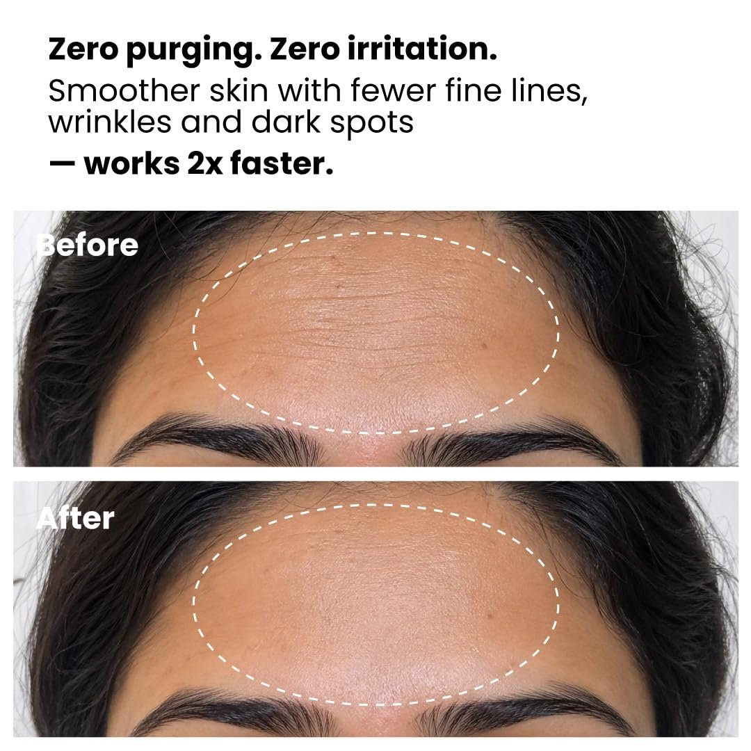 Foxtale 0.15% Beginner Friendly Retinol Night Serum | Anti-Aging Night Cream | Reduces Fine Lines and Wrinkles | No Purging | For Younger-looking Skin | Men & Women | All Skin Types - 10 ml thumbnail