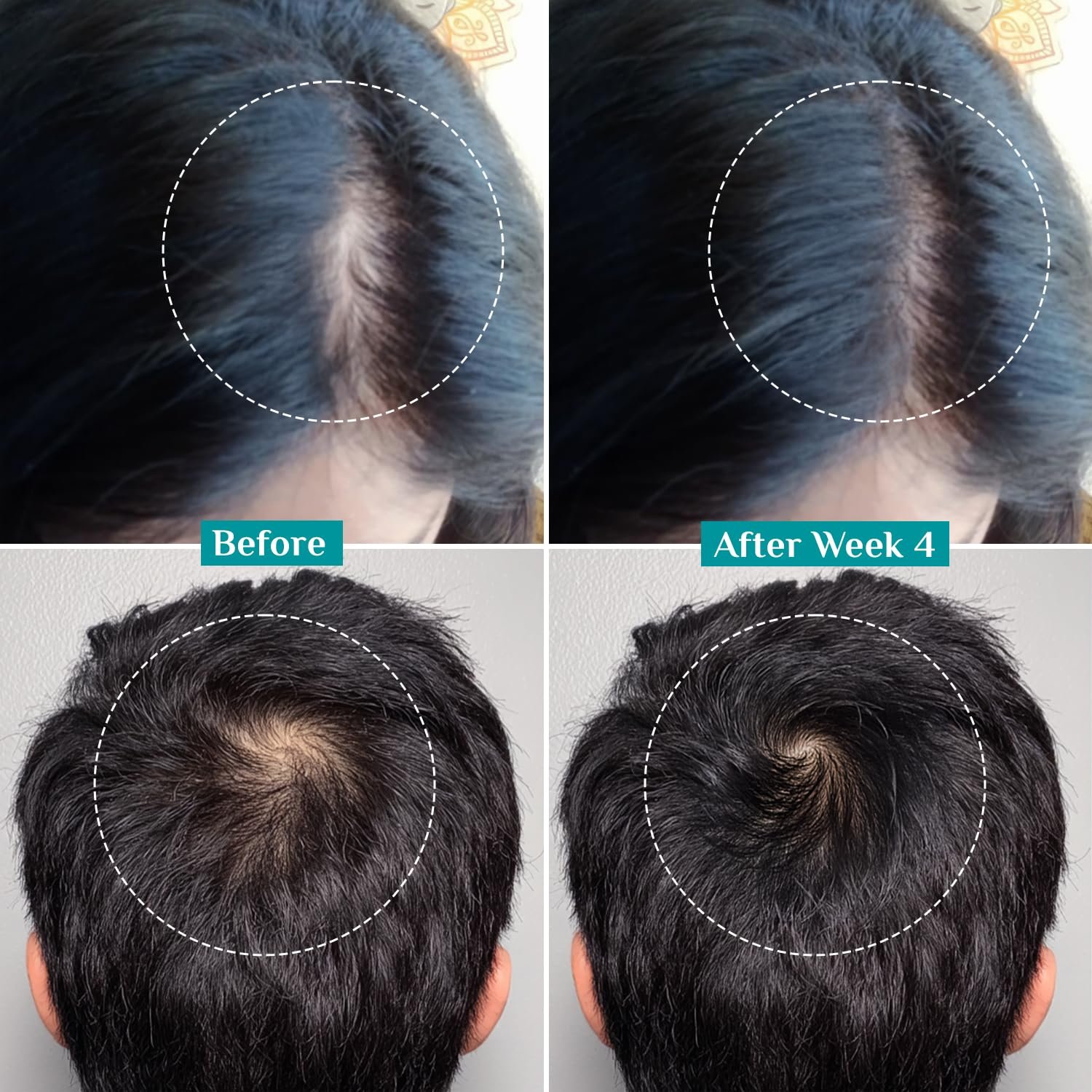 Pilgrim Advanced Hair Growth Serum Roll On with Redensyl & AnaGain - 25ml New Hair Growth in 28 Days, Korean Black Rice, Rosemary, Reduce Hair Fall, Hair Regrowth, Increase Hair Density, Thi thumbnail