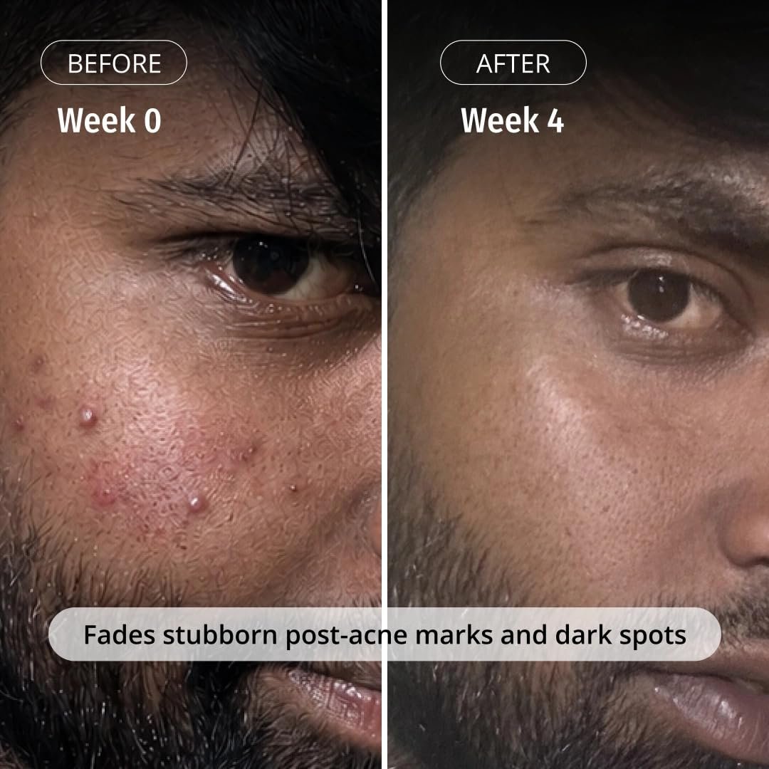 Vilvah Milk Drops Brightening Serum | Fades Dark Spots, Treats Hyperpigmentation & Evens Skin Tone | Hyaluronic Acid & Alpha Arbutin Serum for Women & Men | Suitable for All Skin Types | 20m thumbnail