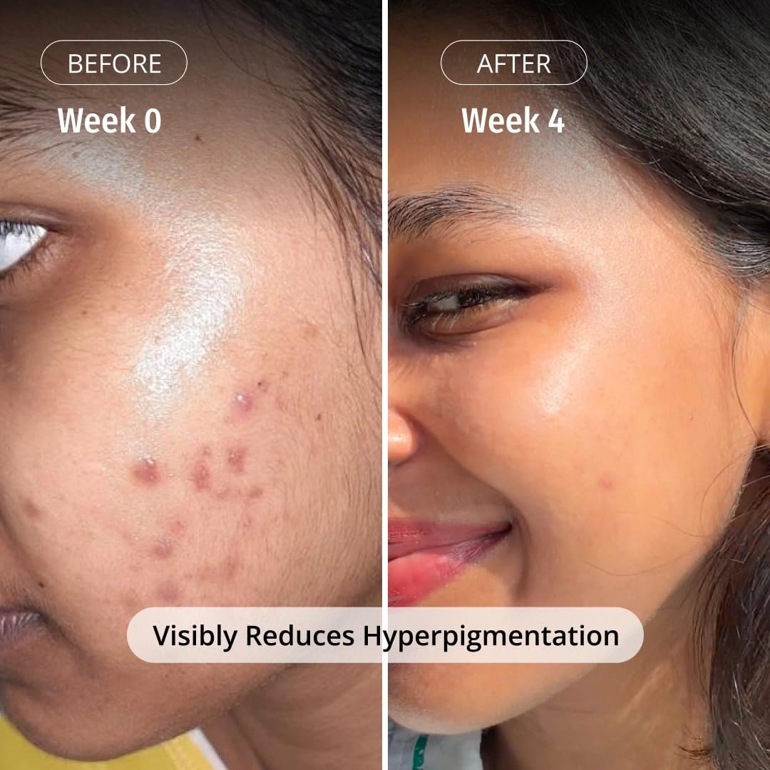 Vilvah Milk Drops Brightening Serum | Fades Dark Spots, Treats Hyperpigmentation & Evens Skin Tone | Hyaluronic Acid & Alpha Arbutin Serum for Women & Men | Suitable for All Skin Types | 20m thumbnail