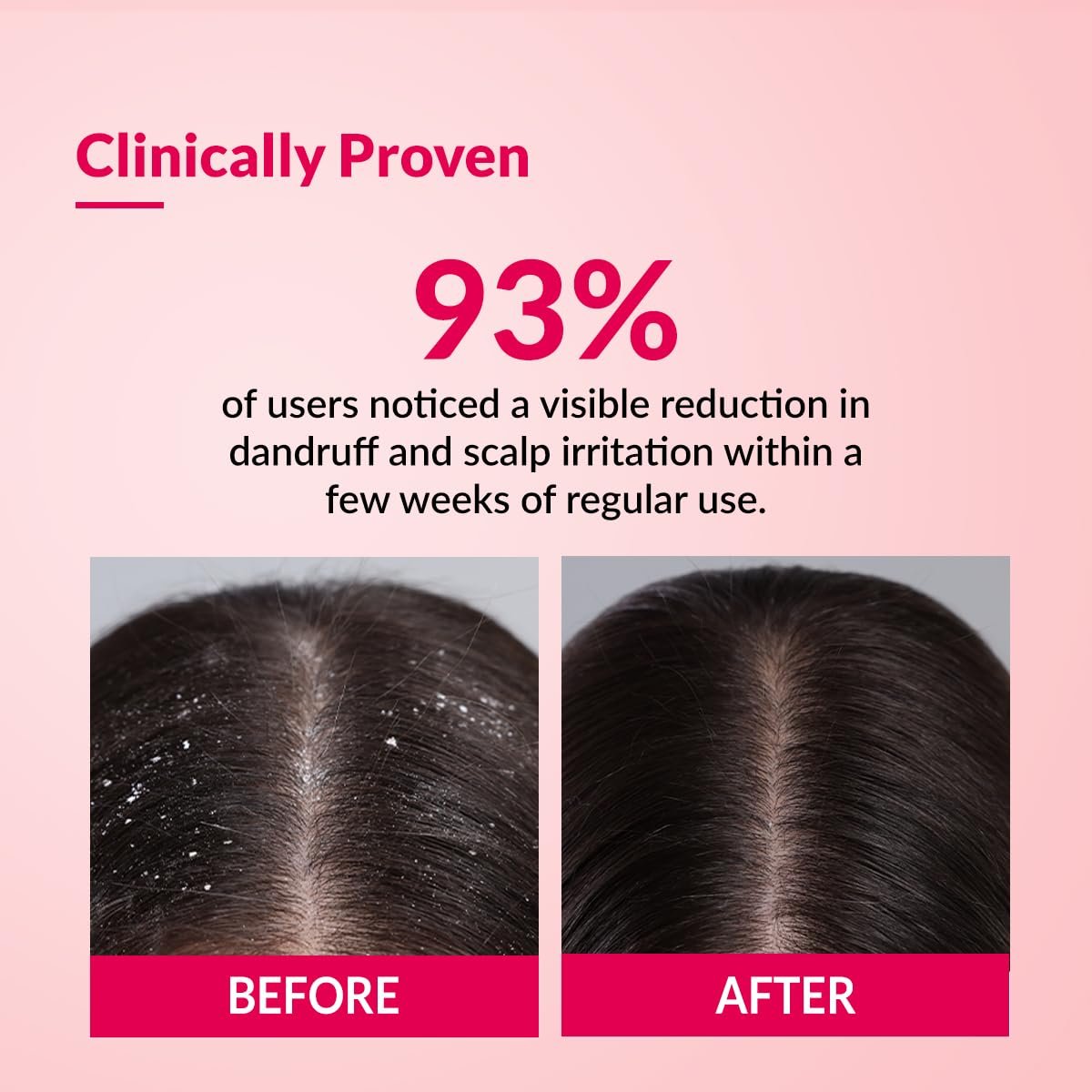 Fixderma Bioteez-S, Anti Dandruff Shampoo, Flaky Scalp Condition, Nourish Dry Hair, Relieves Itchy & Dry Scalp, Recurrent Dandruff, Sulphate & Paraben Free Formulation - 75ml thumbnail