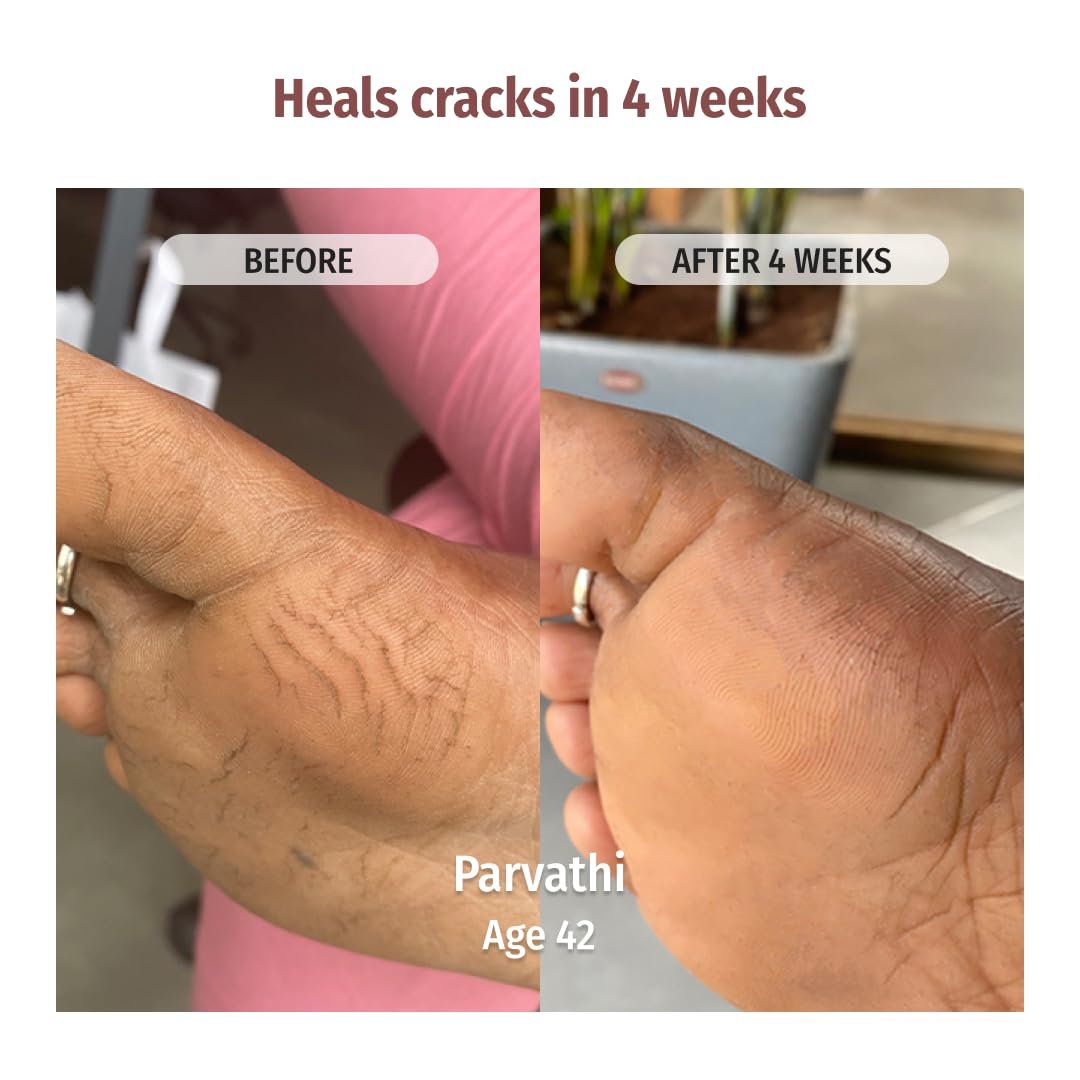 Vilvah Foot Cream for Cracked Heels | Repairs Dry, Rough & Damaged Feet | Softens Calluses & Removes Dead Skin | Deep Hydration & Odour Control | 100ml thumbnail