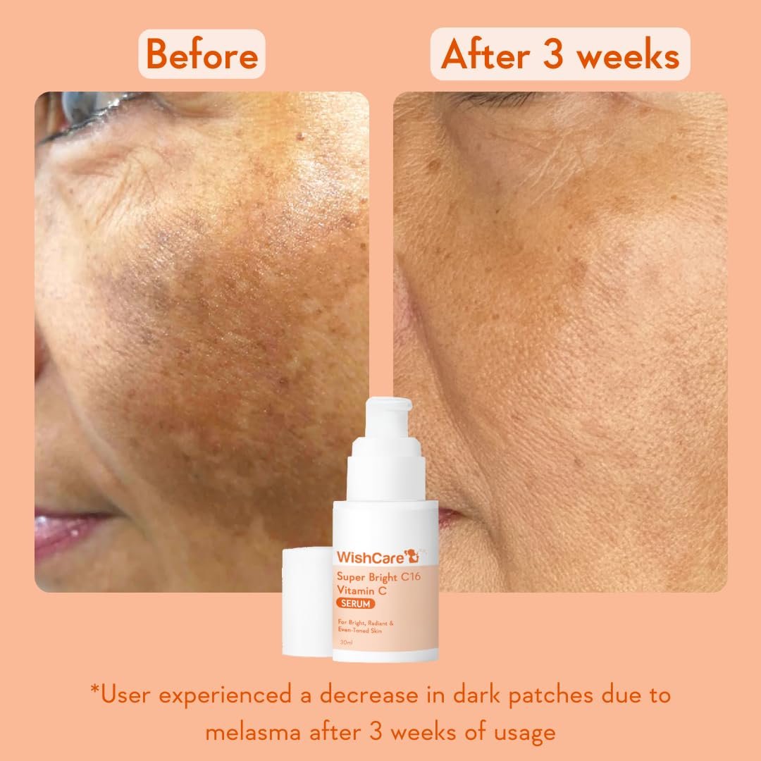 WishCare Super Bright C16 10% Vitamin C Serum For Glowing Skin | With 10% Vitamin C, Niacinamide & Kojic Acid |   For Oily Skin, Dry & Combination Skin | 30ml thumbnail