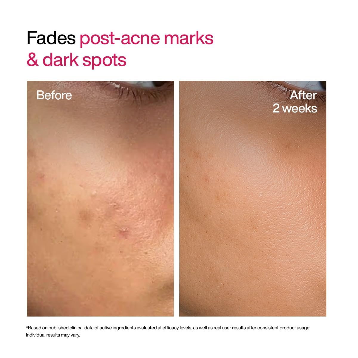 WishCare Advanced Dark Spot Correcting Serum - Niacinamide TXA Shot | 10% Niacinamide Face Serum For Pigmentation and Dark Spot | With 2% Alpha Arbutin & TXA for Glowing Skin | 10ml thumbnail