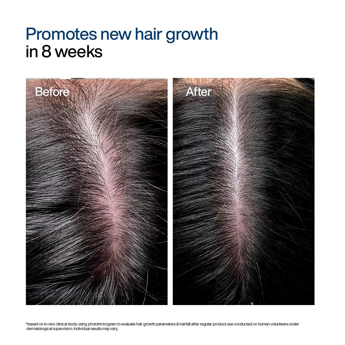 WishCare Hair Growth Serum Roll On For Scalp | 94% Saw New Hair Growth | Redensyl & Rosemary Oil | 100% Saw Hairfall Reduction | In-Vivo Tested | For Men & Women | 30ml thumbnail