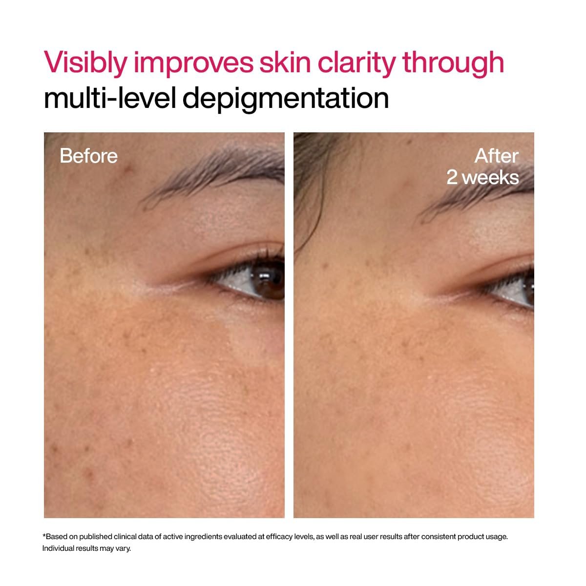 WishCare Advanced Dark Spot Correcting Serum - Niacinamide TXA Shot | 10% Niacinamide Face Serum For Pigmentation and Dark Spot | With 2% Alpha Arbutin & TXA for Glowing Skin | 10ml thumbnail