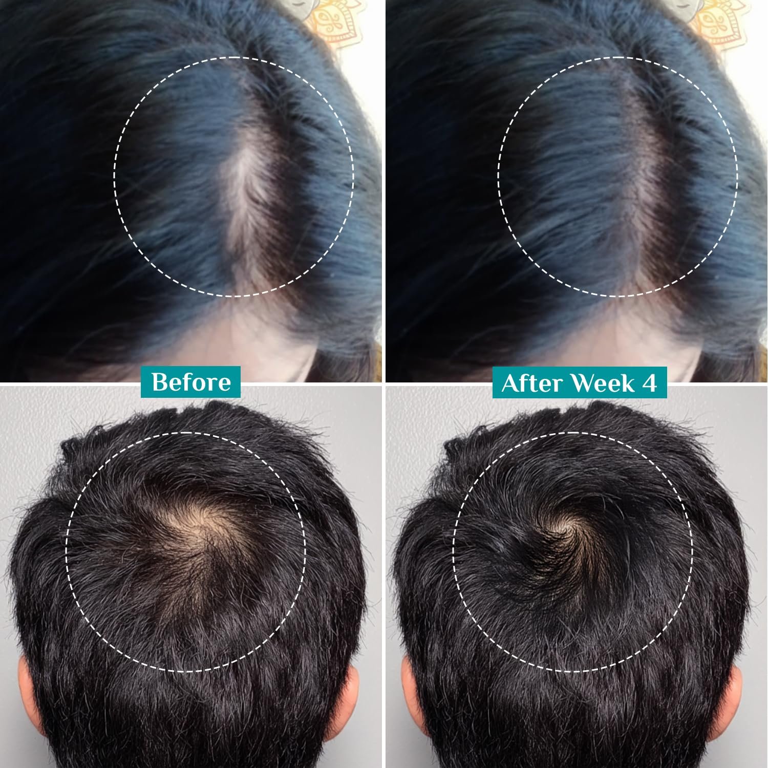 Pilgrim Advanced Hair Growth Serum with 3% Redensyl & 4% AnaGain -100ml New Hair Growth in 28 Days, Korean Black Rice, Rosemary, Reduce Hair Fall, Hair Regrowth, Increase Hair Density, Thick thumbnail