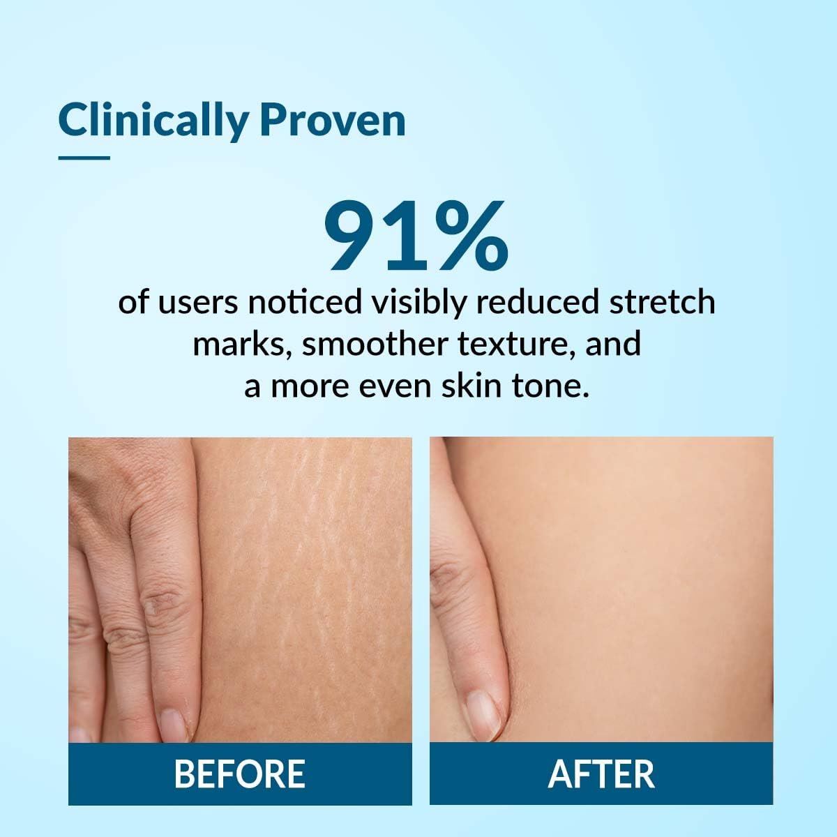 Fixderma Strallium Stretch Mark Cream, Removes Pregnancy stretch marks, Scar removal and Moisturizing Cream, Stretch mark remover for Stomach, thighs & all body parts- 75g thumbnail