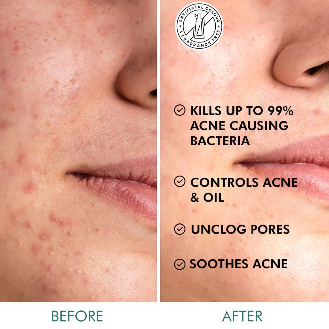mCaffeine 2% Salicylic Acid Zinc PCA & Matcha Tea Clear Skin Acne Pads | Anti Acne Exfoliating Serum Toner Pads for Acne-Prone Skin | For both Women and Men - 40 N (x1) thumbnail