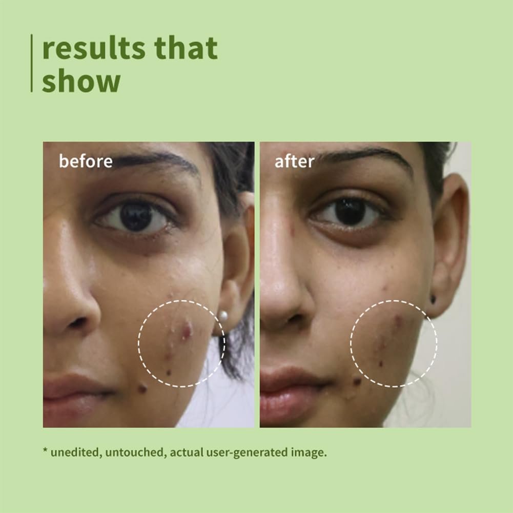 Plum Green Tea Pore Cleansing Face Wash for Oily, Acne Prone, Dry & Combination Skin | with Glycolic Acid thumbnail