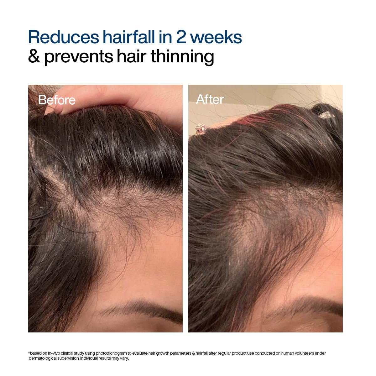WishCare Hair Growth Serum Roll On For Scalp | 94% Saw New Hair Growth | Redensyl & Rosemary Oil | 100% Saw Hairfall Reduction | In-Vivo Tested | For Men & Women | 30ml thumbnail