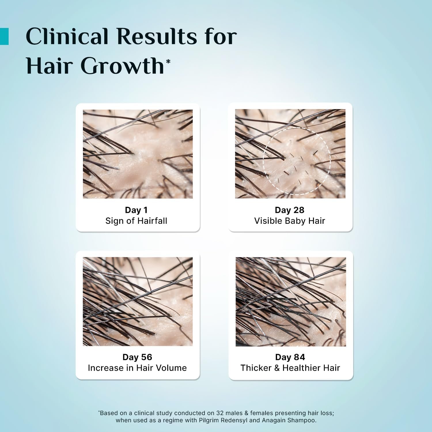 Pilgrim Advanced Hair Growth Serum with 3% Redensyl & 4% AnaGain -30ml New Hair Growth in 28 Days, Korean Black Rice, Rosemary, Reduce Hair Fall, Hair Regrowth, Increase Hair Density, Thicke thumbnail