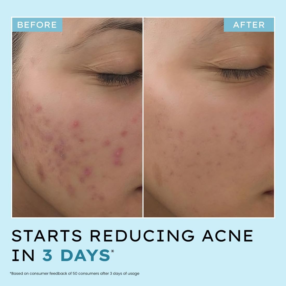 Hyphen 2% Salicylic Acid Serum for Acne Control | 10% Azelaic Acid to control acne marks | 4% Niacinamide| Exfoliating, Pore Cleansing & Blackheads Control Serum| For Oily & Acne Prone Skin thumbnail