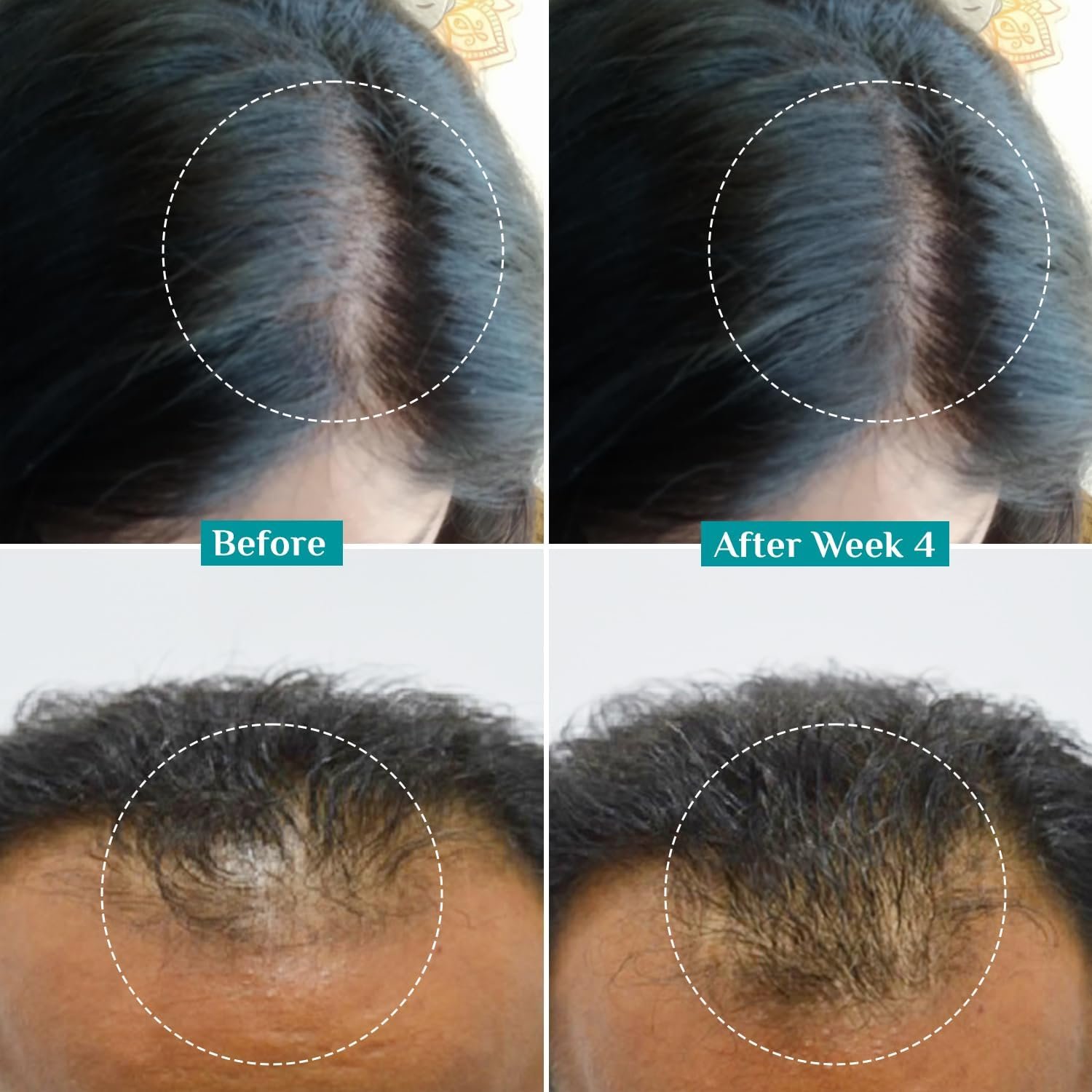 Pilgrim Advanced Hair Growth Serum with 3% Redensyl & 4% AnaGain -30ml New Hair Growth in 28 Days, Korean Black Rice, Rosemary, Reduce Hair Fall, Hair Regrowth, Increase Hair Density, Thicke thumbnail