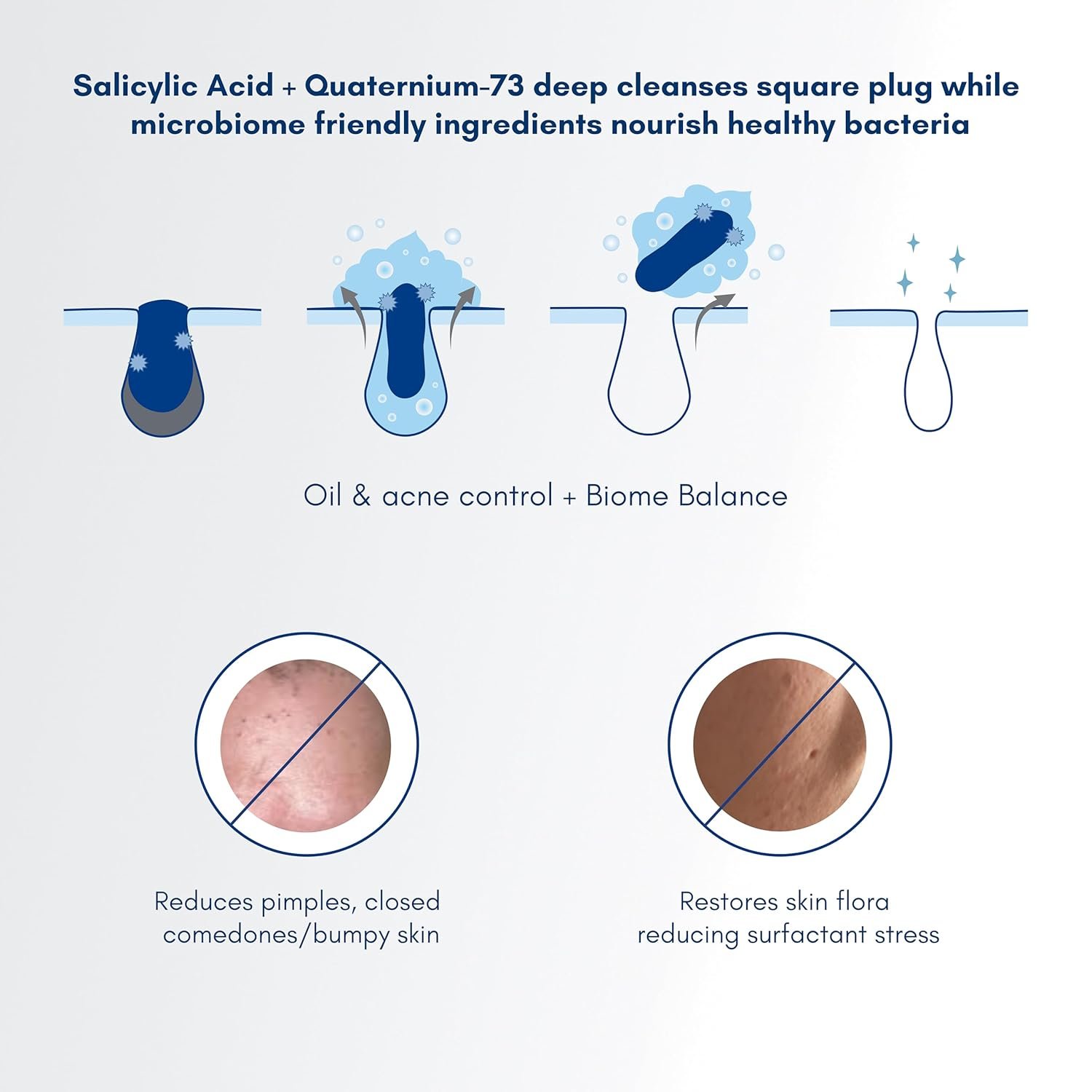 Becalm Daily Salicylic Acid Face Wash for Oily & Acne Prone Skin | Airy face wash for Men & Women | Soap & Sulphate free | Microbiome friendly | With Quaternium - 73 & Prebiotic | No fragran thumbnail