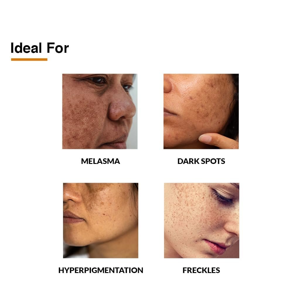 Fixderma 2% Kojic Acid + 1% Arbutin Skarfix-Plus Scar Removal Cream | Hyperpigmentation Removal Cream and Acne Scars Removal Cream | Helps to Reduce Melasma- 15 g thumbnail