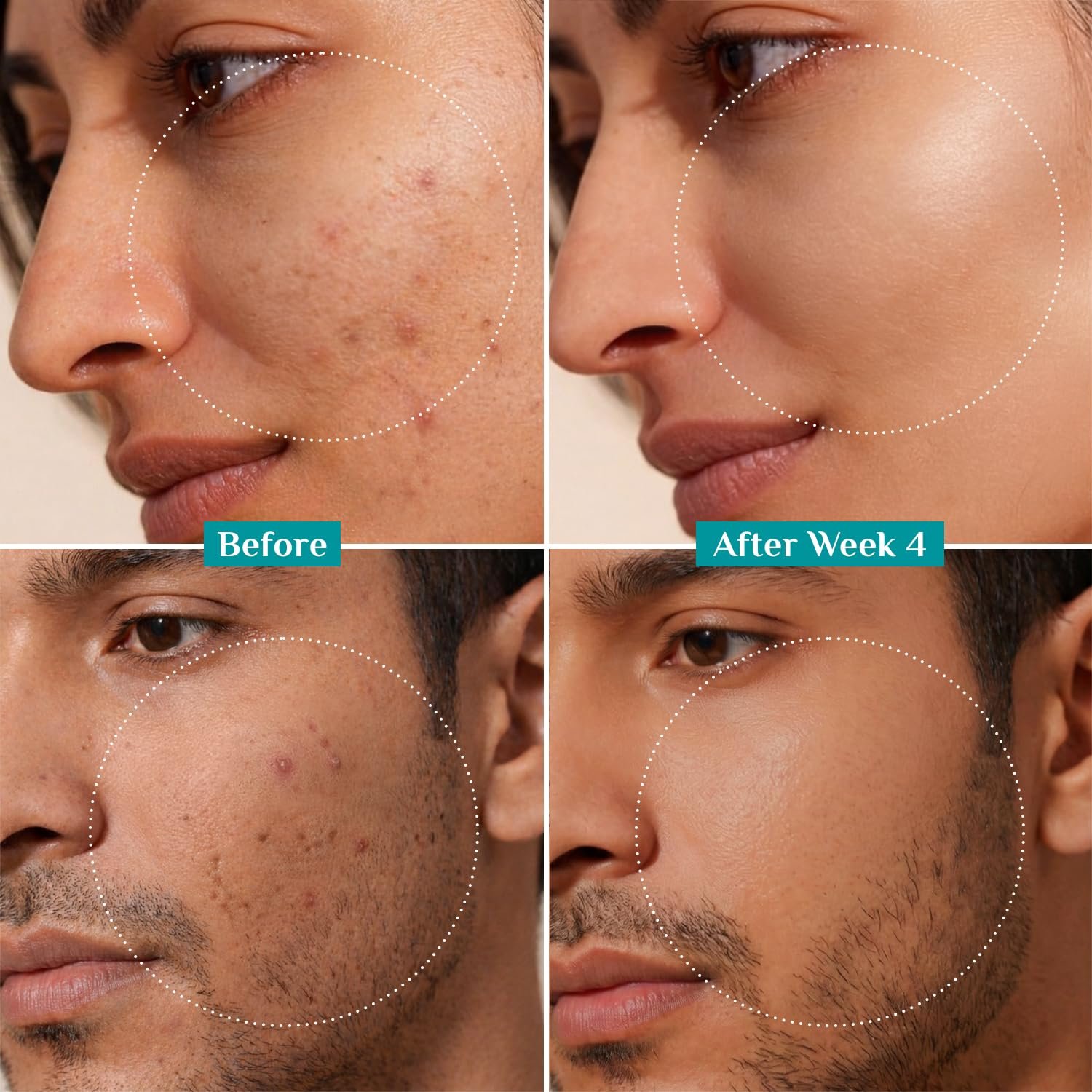 Pilgrim 10% Niacinamide Face Serum for Acne Marks & Glass Skin Glow - 30ml with Kojic Acid & Korean Rice Water, Fades Dark Spots, Boosts Glow, Minimizes Pores, Controls Excess Oil, Sensitive thumbnail