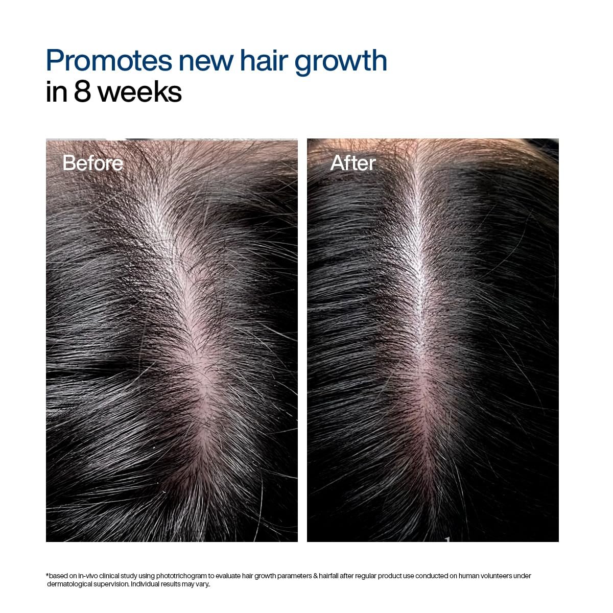 WishCare Hair Growth Serum For Scalp | 94% Saw New Hair Growth | Redensyl & Rosemary Oil | 100% Saw Hairfall Reduction | In-Vivo Tested | For Men & Women | 30ml thumbnail