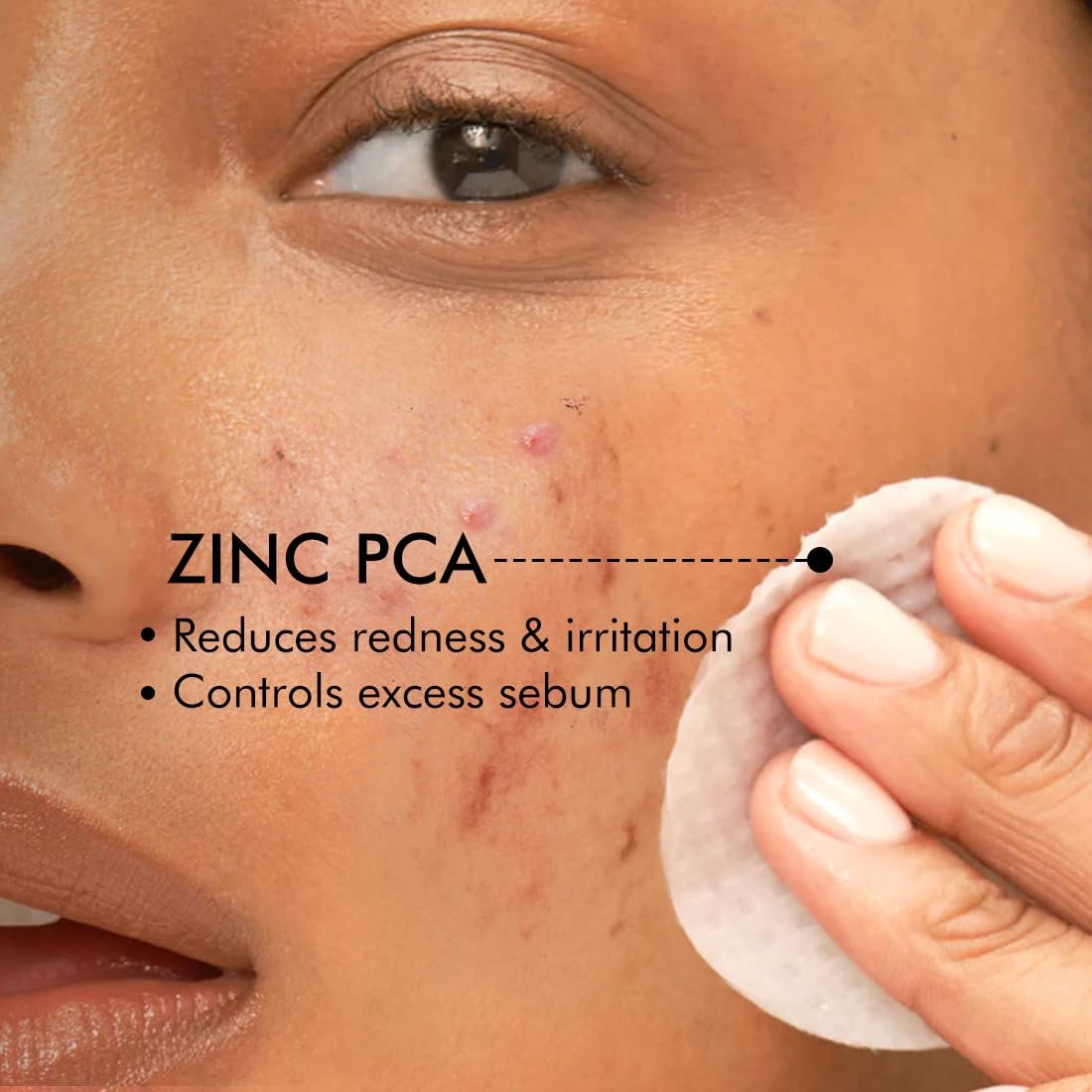 mCaffeine 2% Salicylic Acid Zinc PCA & Matcha Tea Clear Skin Acne Pads | Anti Acne Exfoliating Serum Toner Pads for Acne-Prone Skin | For both Women and Men - 40 N (x1) thumbnail
